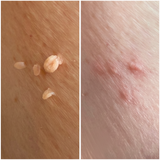 Fjerning av skin tag og sktilkvorter hos Fresh Up Hudpleie Greverud, Oppegård, Kolbotn