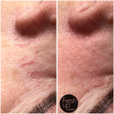 Sprengte blodårer i ansiktet kan fjernes. Book time hos Fresh Up Hudpleie