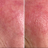 Behandling av sprengte blodkar (couperose) i ansiktet
Sliter du med synlige, sprengte blodårer eller rødhet i huden? Vi tilbyr en effektiv og skånsom behandling som lukker de utvidede blodkarene og reduserer rødhet og synlige kar i ansiktet.