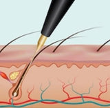 Elektrolyse Strømførende nål føres ned i hårsekken og fjerner hår permanent Fresh Up Hudpleie