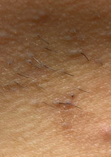 Uønsket hårvekst i ansiktet Elektrolyse hårfjerning med strøm