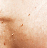 Med Diatermi strøm fjerner vi små skin tags og stilkvorter i ansikt og på kropp