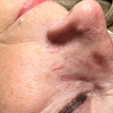 Sprengte blodkar i ansikt fjernes.