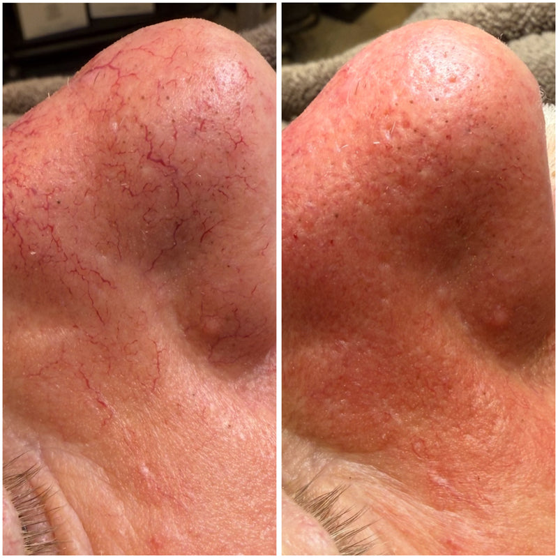 Behandlingen som fjerner sprengte blodårer i ansiktet. Behandling av sprengte blodkar i ansiktet (couperose) Behandlingen lukker blodkaret og reduserer rødhet i huden.