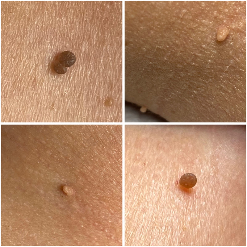 Vi fjerner skin tags, stilkvorter og utvekster permanent. Behandlingen utføres med diatermi strøm, raskt og effektivt.