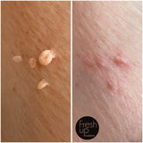 Skin tags og stilkvorte fjerning