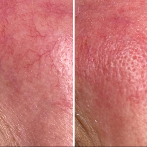 Behandling av sprengte blodkar (couperose) i ansiktet
Sliter du med synlige, sprengte blodårer eller rødhet i huden? Vi tilbyr en effektiv og skånsom behandling som lukker de utvidede blodkarene og reduserer rødhet og synlige kar i ansiktet.