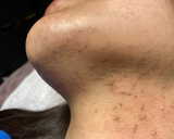 Permanent hårfjerning med elektrolyse/ blend fjerner sjenerende hårvekst i ansiktet og på hals